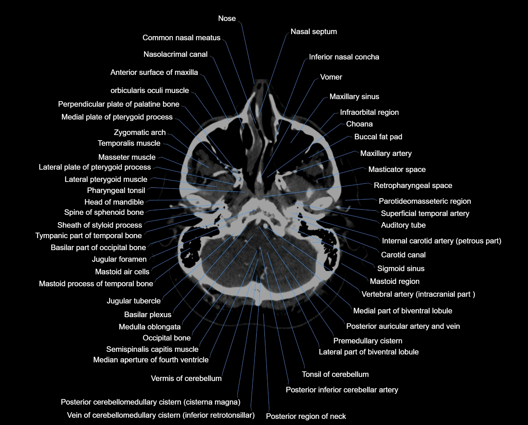 CT scan brain axial labelled cross sectional anatomy image-img-00009.webp
